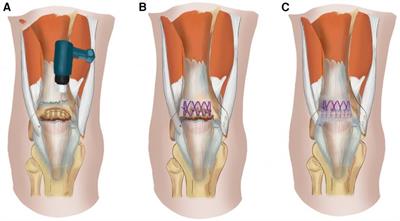 A retrospective case series of the treatment of spontaneous quadriceps tendon rupture in patients with uremia and secondary hyperparathyroidism